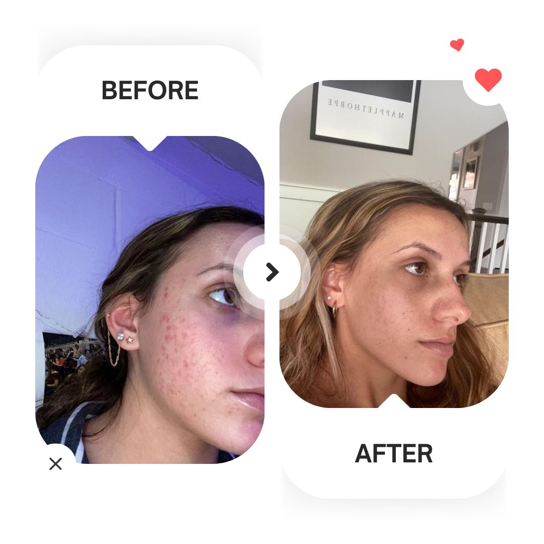 Alpha Arbutin 2% + HA (Dark Spots Remover)